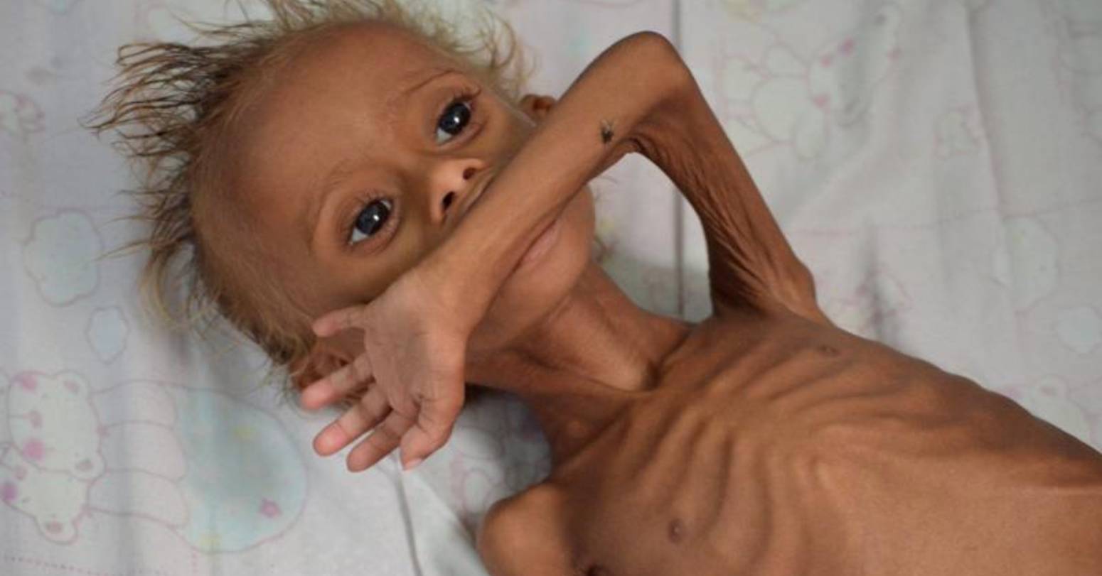 बाँकेमा कुपोषित बालबालिकाको सङ्ख्या बढ्यो