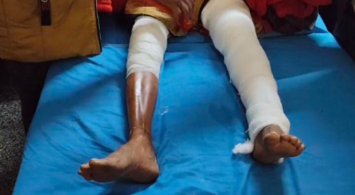 बायाँ खुट्टा भाँचिएको थियो, डाक्टरले गरेदायाँ खुट्टाको अप्रेसन