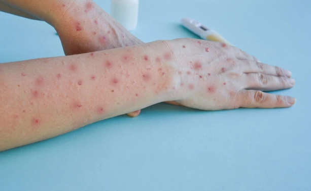 साउदीबाट आएका थप एक नेपालीमा मङ्किपक्स पुष्टि