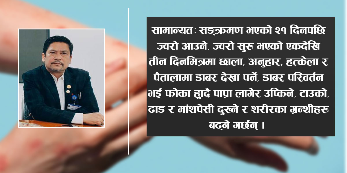 नेपालमा एम–पक्सको सर्तकता तथा निगरानी